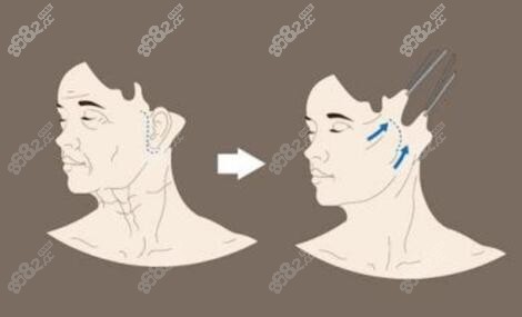 颧骨内推+下颌角+拉皮手术能否一起做