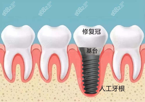 种植体的质量测试