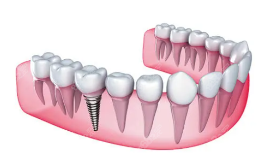 即刻種植牙和延期種植哪個好