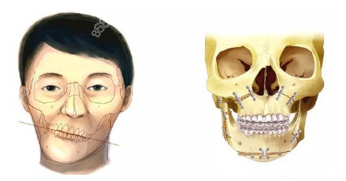 骨性偏颌要做正颌手术