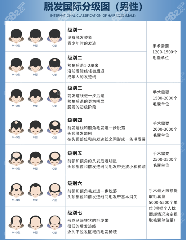 地中海脱发等级图，建议植发多少毛囊单位