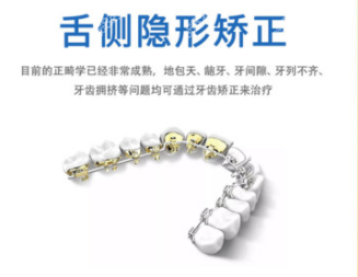 舌側(cè)矯正牙套解釋