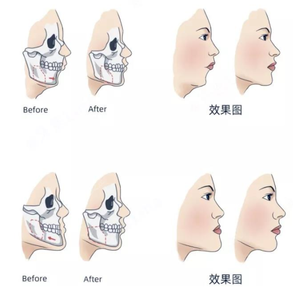 正颌手术前后对比图