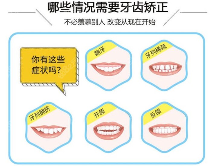 來看看牙齒矯正適應(yīng)癥有哪些吧 來看看牙齒矯正適應(yīng)癥有哪些吧