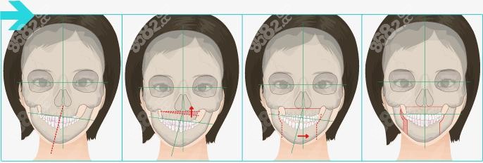 偏颌做正颌手术后脸型的改变图