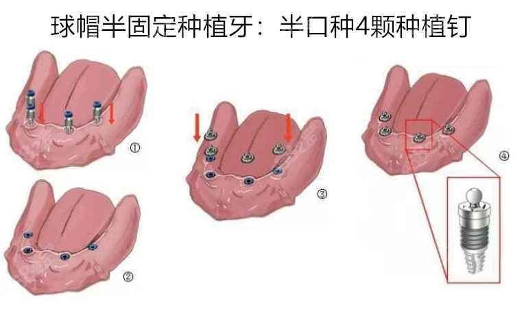 半口球帽半固定种植牙