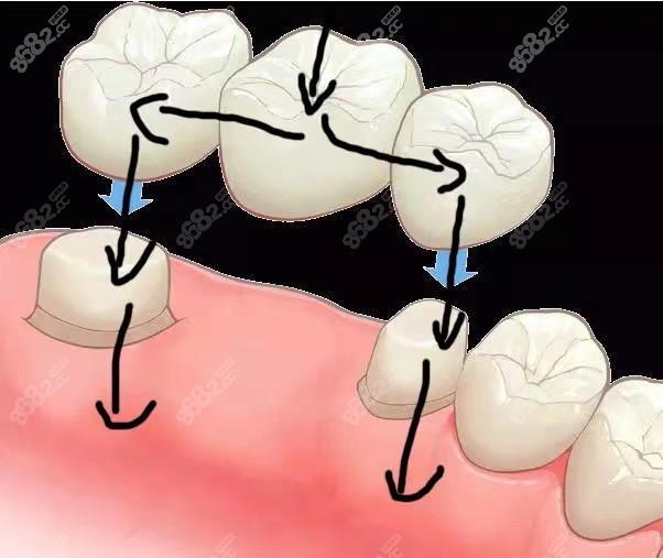 门牙镶牙过程图解图片