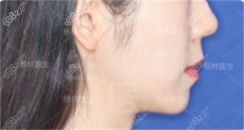 <!--<i data=20240705-sp></i>-->口腔楊林院長骨性凸嘴矯治后側(cè)面流暢 <!--<i data=20240705-sp></i>-->口腔楊林院長骨性凸嘴矯治后側(cè)面流暢