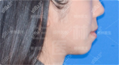 <!--<i data=20240705-sp></i>-->口腔楊林院長骨性凸嘴矯治前側(cè)面不流暢 <!--<i data=20240705-sp></i>-->口腔楊林院長骨性凸嘴矯治前側(cè)面不流暢