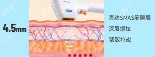 半岛超声炮4.5mm作用层次和功效