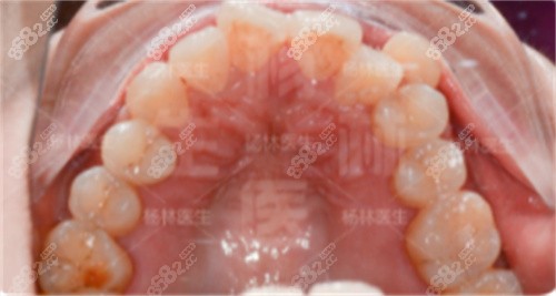 <!--<i data=20240705-sp></i>-->口腔楊林院長骨性凸嘴矯治前牙弓錯(cuò)亂 <!--<i data=20240705-sp></i>-->口腔楊林院長骨性凸嘴矯治前牙弓錯(cuò)亂