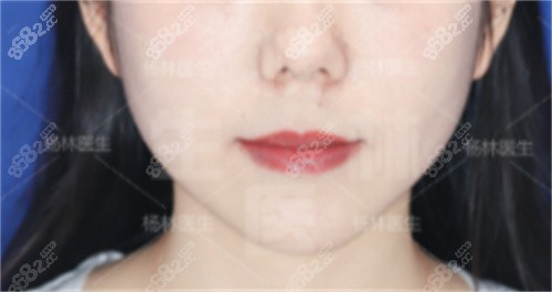 <!--<i data=20240705-sp></i>-->口腔楊林院長骨性凸嘴矯治前正面 <!--<i data=20240705-sp></i>-->口腔楊林院長骨性凸嘴矯治前正面