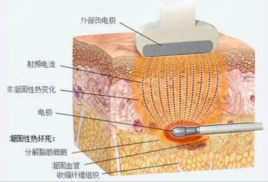 钻石微雕吸脂作用图示