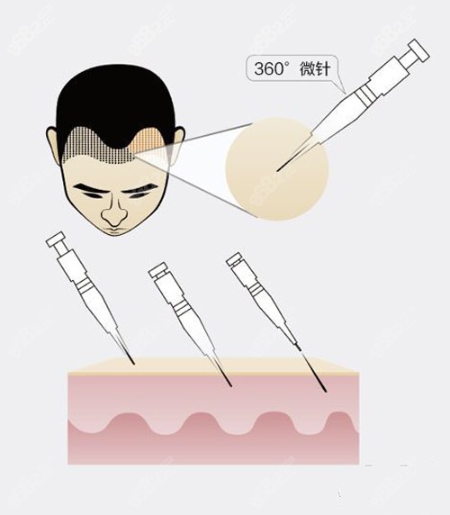 在深圳做微针植发需要多少钱呢