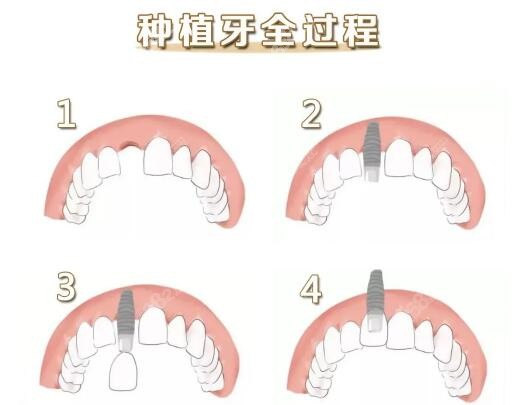 海口种植牙医院排名前三公布