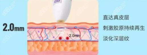 半岛超声炮2.0mm作用层次和功效