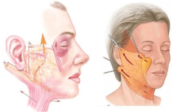 面部拉皮手术提升
