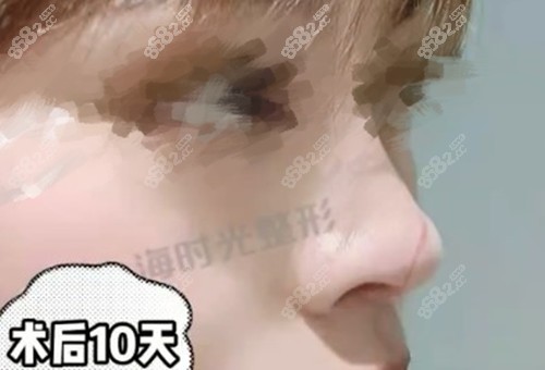上海時(shí)光宋茂啟做4D彈性保留鼻術(shù)后10天 上海時(shí)光宋茂啟做4D彈性保留鼻術(shù)后10天