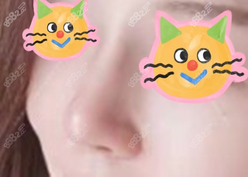 上海時(shí)光宋茂啟做4D彈性保留鼻術(shù) 上海時(shí)光宋茂啟做4D彈性保留鼻術(shù)