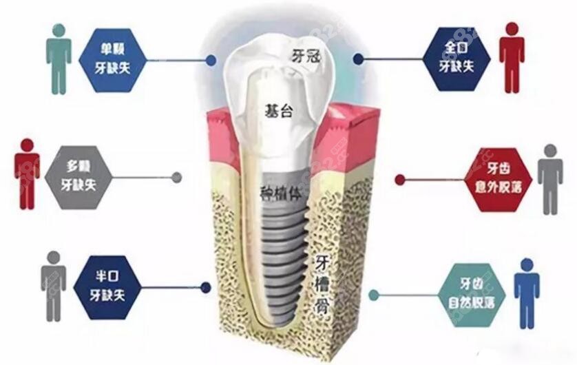 种植牙结构图
