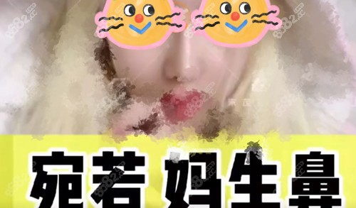 上海時(shí)光宋茂啟做4D彈性保留鼻術(shù) 上海時(shí)光宋茂啟做4D彈性保留鼻術(shù)