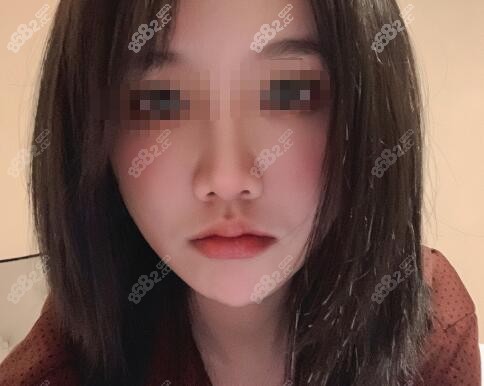 胡俊杰醫(yī)生人中縮短術(shù)后30天