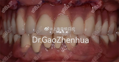 上海鼎植永博口腔<!--<i data=20240705-sp></i>-->华穿颧穿翼种植修复后