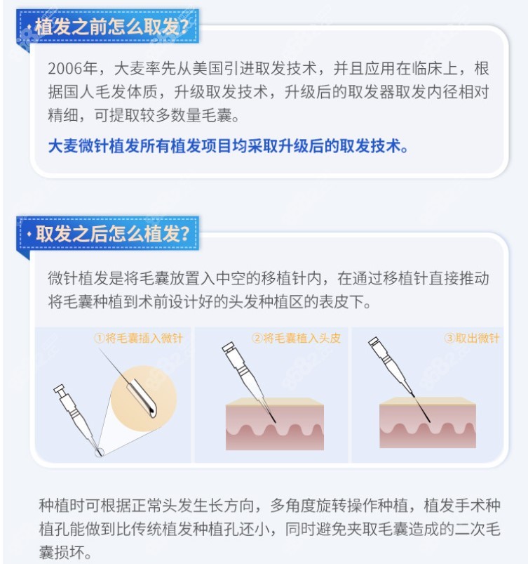 大麦微针植发流程