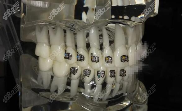 金属钢牙套优势：矫正力度较大
