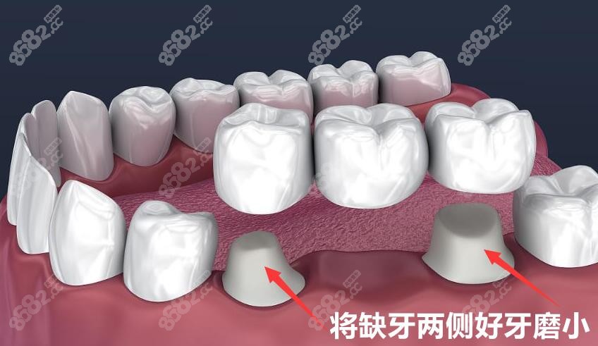 传统镶牙需要磨牙