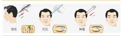 广州男士植眉手术