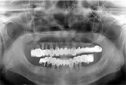 广州穗江口腔医院全口种植牙片显示