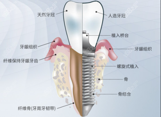 种植牙的结构图