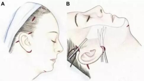 面部小拉皮手术示意图