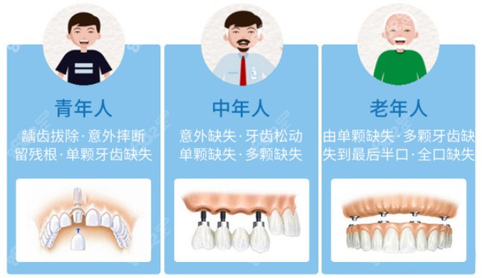 种植牙的适用人群有哪些