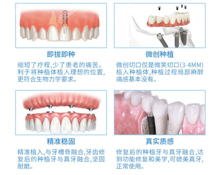 南城博球口腔医院种植牙的优势