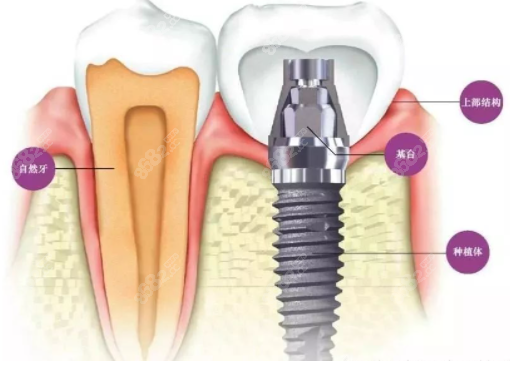 种植牙图示