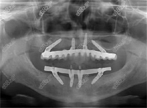 广州穗江口腔医院全口放入植体