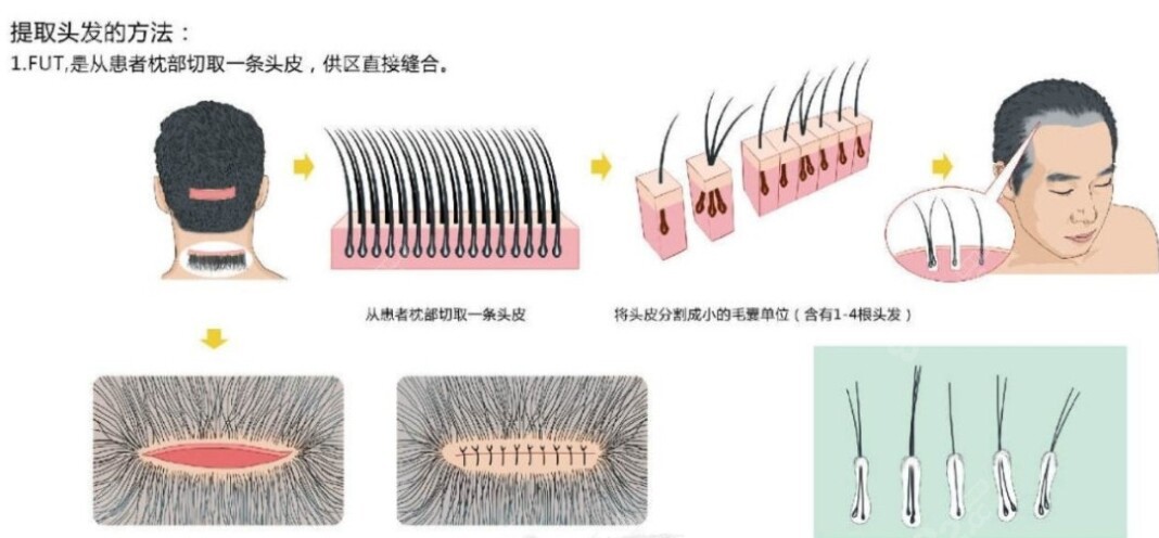 fut植发技术缺点