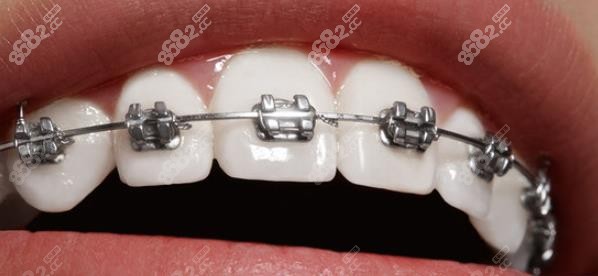 传统金属托槽牙套的优缺点