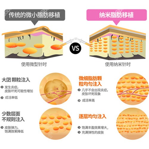 普通颗粒脂肪和纳米脂肪的区别