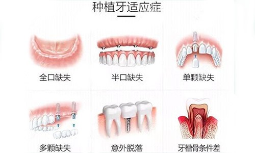 种植牙适应症