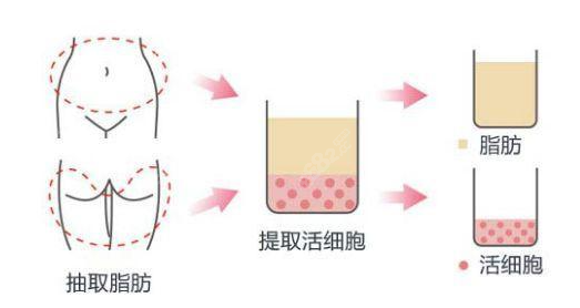北京自體脂填充哪個醫(yī)生好呢？