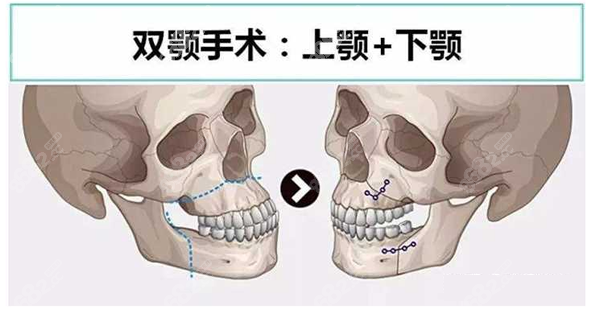 骨性凸嘴双鄂手术前后对比照片