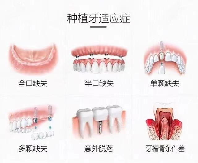 看看哪些牙齿情况适合做种植牙适应症都有哪些