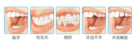 需要做牙齿矫正的5大情况