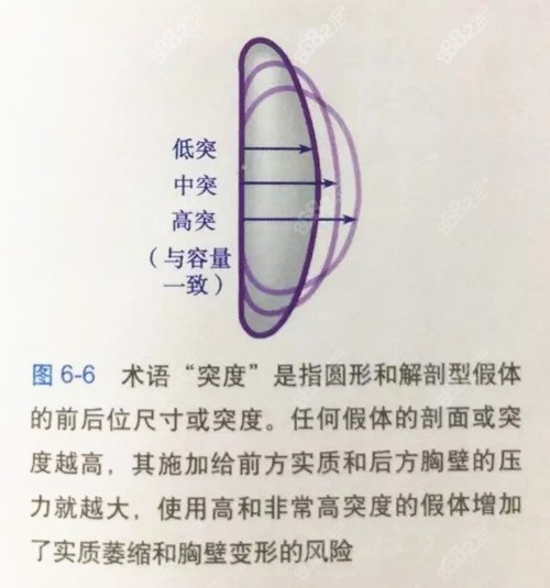 隆胸假体凸度的选择