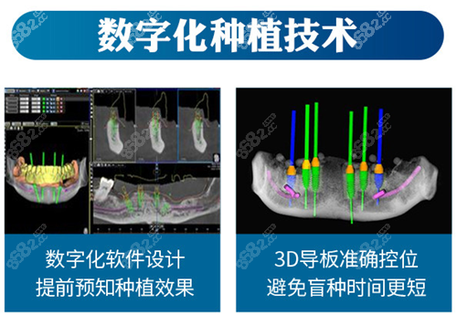 南通牙卫士口腔数字化种植技术