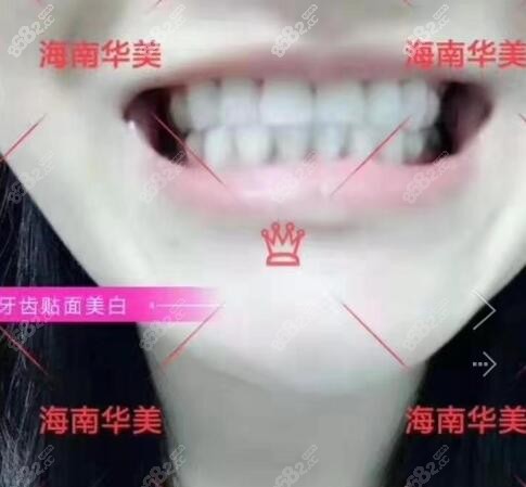 海南华美口腔牙齿贴面美白