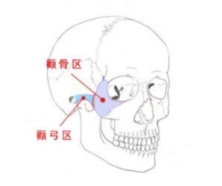 做颧骨内推手术后有骨缝什么原因